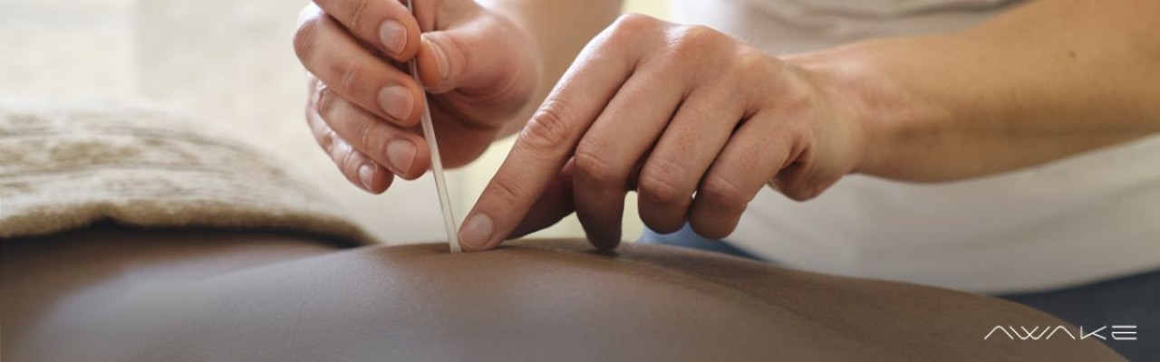 Saúde na ponta das agulhas: descubra os benefícios da acupuntura 